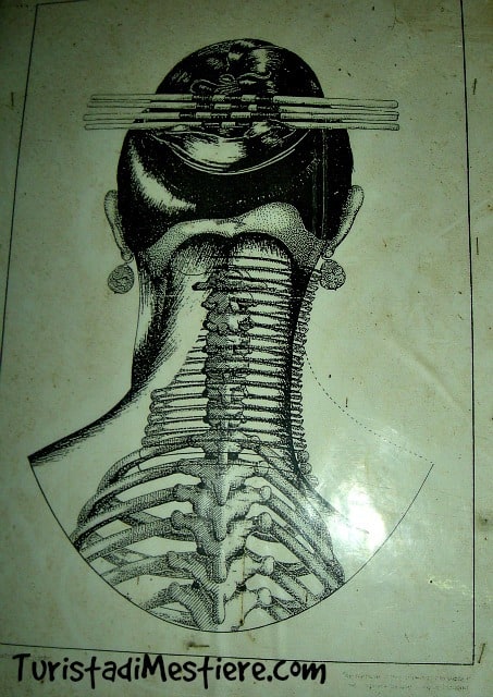 Immagine della deformazione della clavicola a causa degli anelli